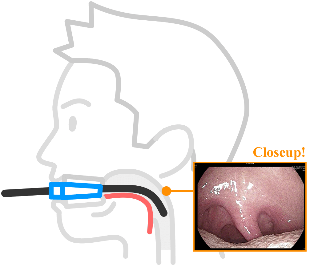 咽頭が広がり、スムーズにカメラが挿入し、咽頭反射が軽減する。